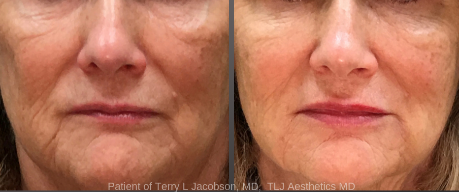 Combining soft tissue fillers and Botox for the best results