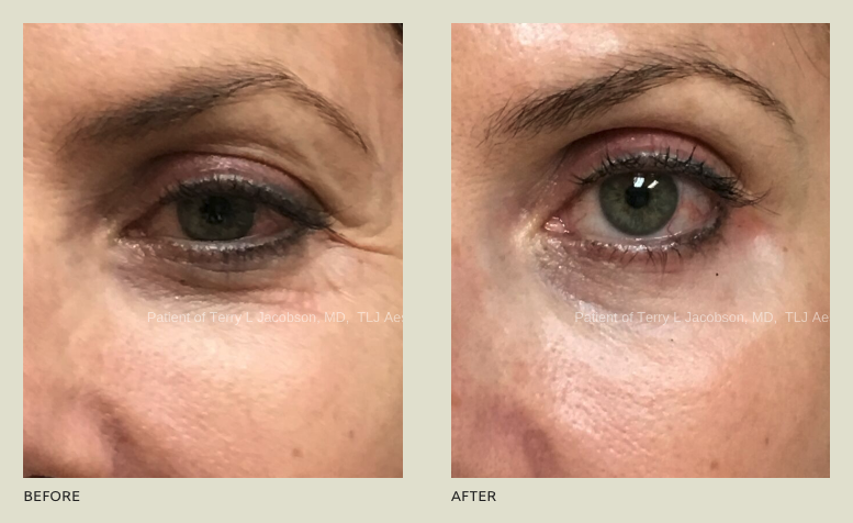 Before after Eye rejuvenation